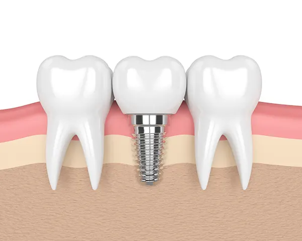 3D rendered cross-section view of a dental implant placed in the jaw between two healthy teeth at East Portland Dentistry 