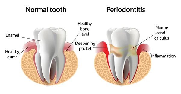 A healthy tooth with another tooth suffering from periodontal disease.